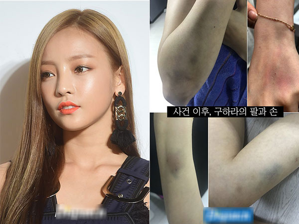 Dispatch bóc mẽ vụ hành hung chấn động: Goo Hara bị chảy máu tử cung, bầm tím nghiêm trọng vì bạn trai đánh