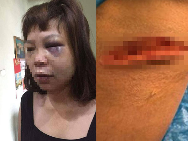 Vì ghen tuông, nữ hộ lý bị chồng dụ lên đồi đánh đập dã man, cắt gân chân