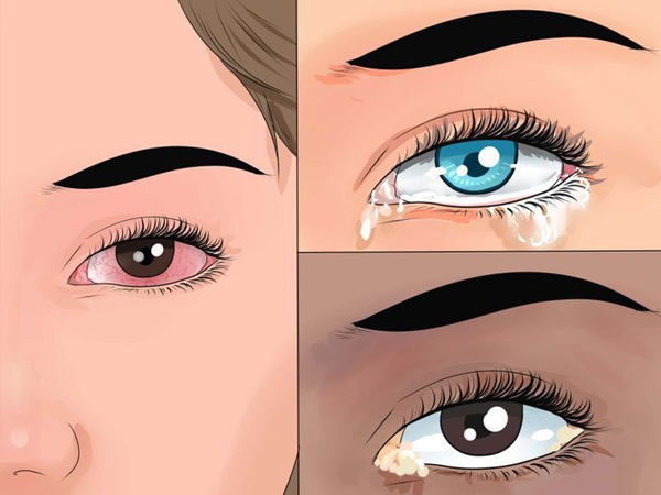 Sáng ngủ dậy thấy mặt sưng phồng có thể là do 4 vấn đề sức khỏe sau đây