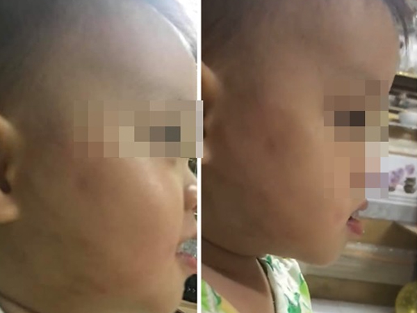 Chủ tịch Hà Nội yêu cầu xác minh vụ phụ huynh 'tố' bé 20 tháng bị đánh ở lớp