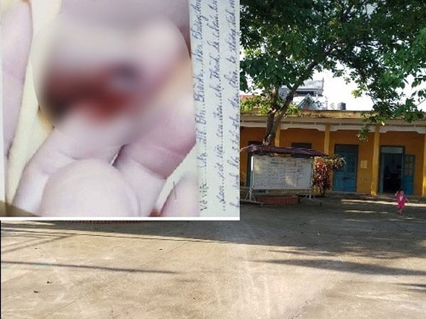 Thực hư thông tin 'cô giáo mầm non vụt chảy máu bộ phận sinh dục bé trai 3 tuổi'