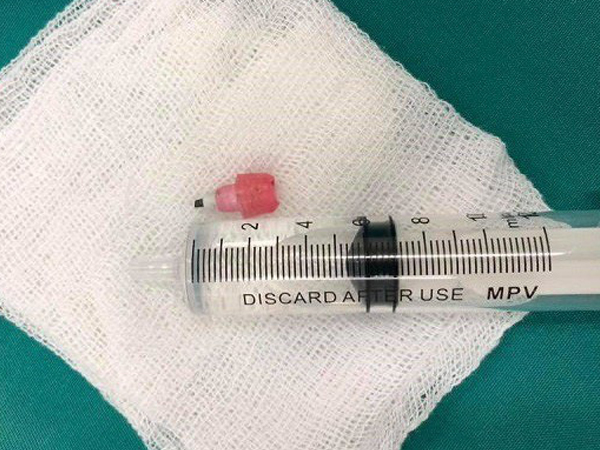 Ngồi học nuốt phải đầu bút chì, bé 6 tuổi toàn thân tím tái ngừng thở