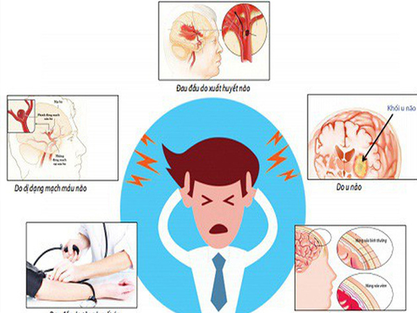 Nhận diện những cơn đau đầu nguy hiểm