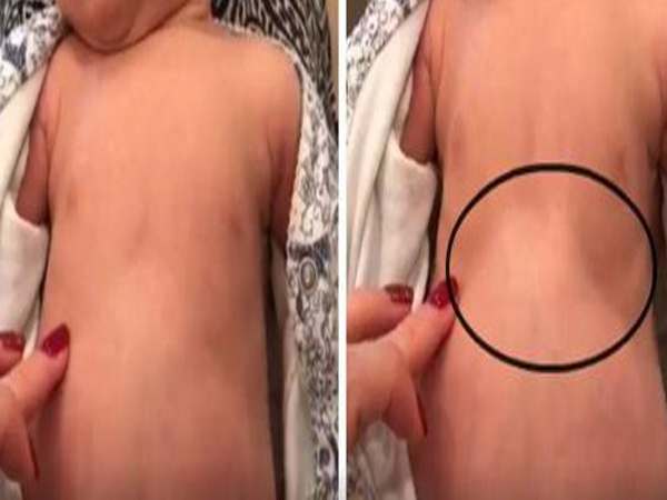 Thấy con thở với dấu hiệu lạ trên ngực, mẹ mau chóng quay lại video giúp cứu sống con