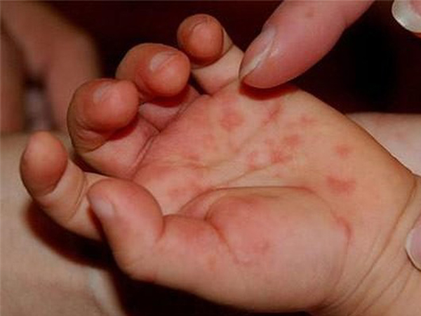 Bệnh tay chân miệng: Biến chứng gây tử vong ở trẻ em cha mẹ không thể bỏ qua