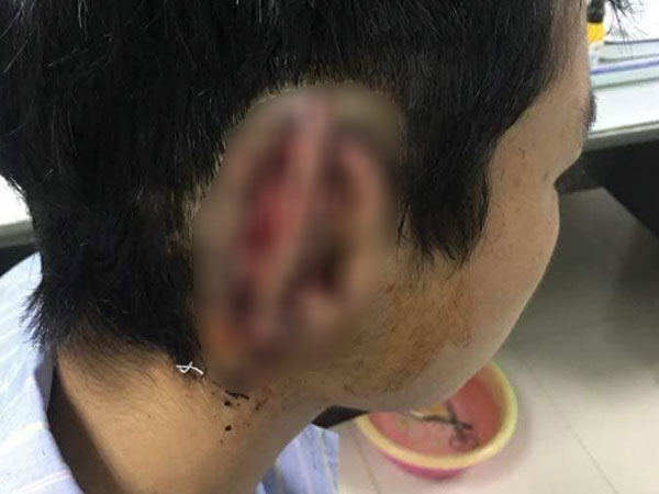 Nam sinh nghi 'ngáo đá' cắn đứt rồi nuốt tai phải của bạn vào bụng