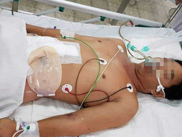 Người đàn ông ở Đồng Nai bị cắt ngang bụng, thủng ruột kinh hoàng do máy cưa vướng vào áo