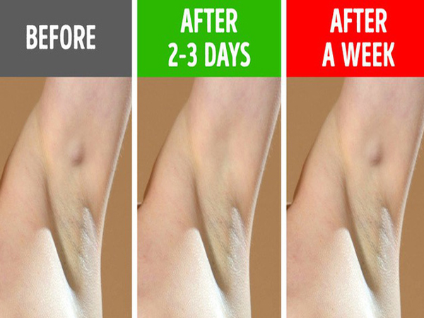 Đừng cố tình bỏ qua 6 biểu hiện ở nách vì nó có thể chỉ ra bệnh tiềm ẩn, không ngoại trừ ung thư