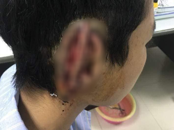 Nam sinh cắn đứt rồi nuốt tai của bạn vào bụng âm tính với ma túy?