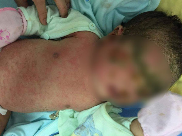 Bé 1 tháng tuổi toàn thân bong tróc mảng lớn vì tắm lá, bác sĩ cảnh báo thói quen có thể khiến trẻ tử vong