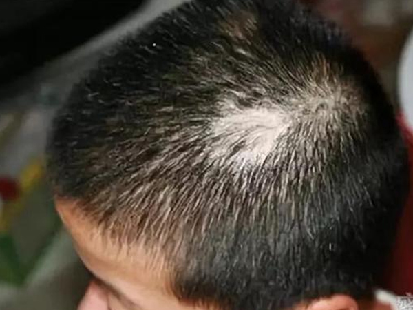 Con trai 3 tuổi đột nhiên bị rụng tóc, nguyên nhân thật sự khiến cha mẹ rất xấu hổ