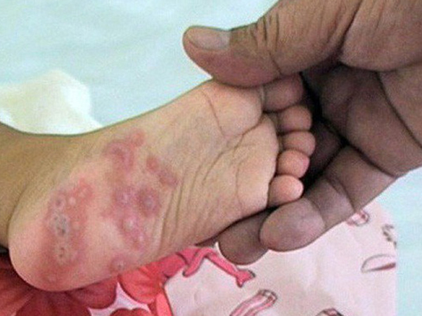 Tay chân miệng có thể biến chứng tử vong: BS bệnh viện Nhi khuyến cáo 4 việc cần làm ngay