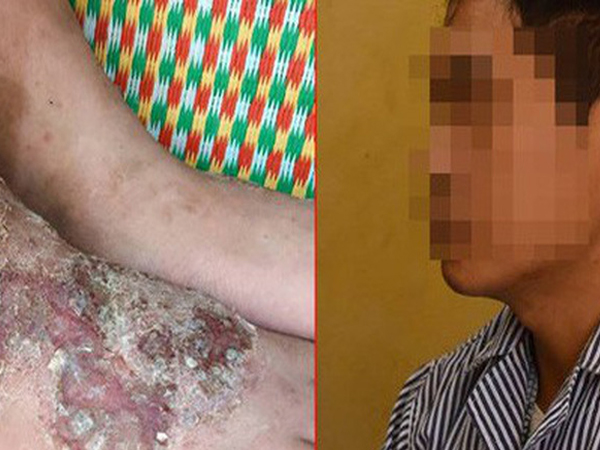 Thích ăn tiết canh, rau sống, nem chua, người đàn ông bị đau gan vì nguyên nhân không ngờ