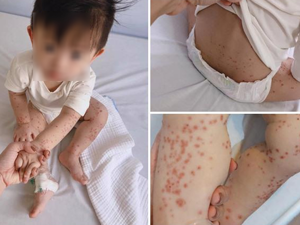 Ủ bệnh 10 ngày, bé trai 20 tháng được phát hiện mắc tay chân miệng nặng nhất bệnh viện