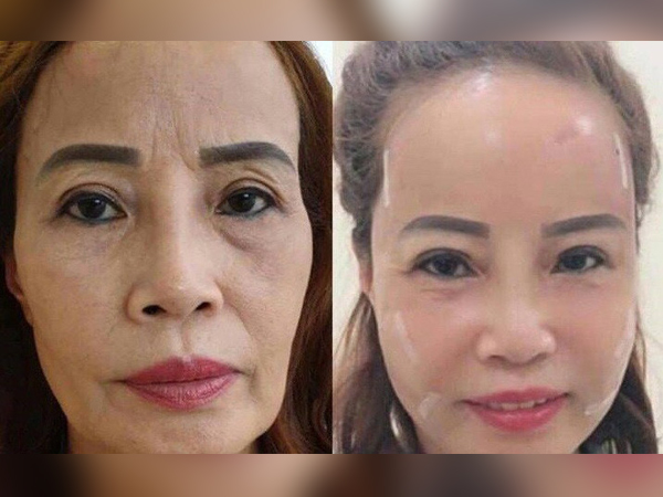 Sau khi đưa chồng trẻ đi nhấn mí, cô dâu 62 tuổi lại gây sốc với gương mặt 'trẻ ra 20 tuổi' nhờ PTTM