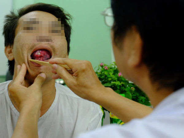 Từ 1 vết loét nhỏ trong miệng, chàng trai 19 tuổi bàng hoàng khi biết mình là bệnh nhân trẻ nhất bị ung thư lưỡi