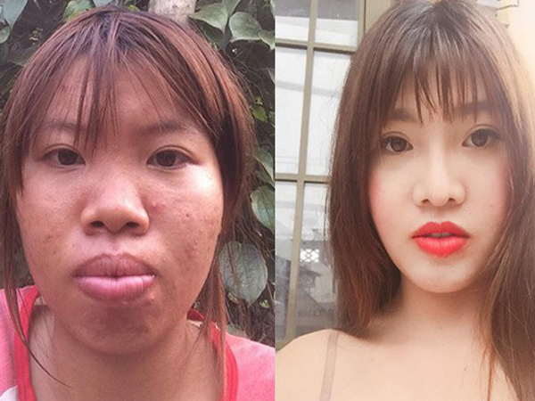 Phượng 'Thị Nở' bất ngờ bị ngã trầy xước mặt mũi sau gần 2 năm thẩm mỹ khiến nhiều người lo lắng