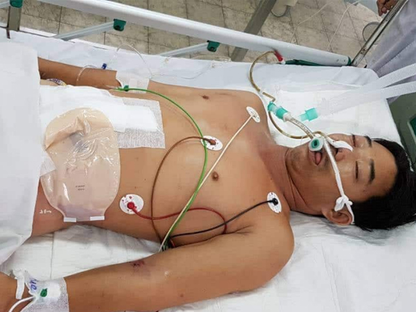 Người đàn ông sống sót thần kỳ sau 27 ngày điều trị vì bị cưa máy cắt ngang bụng kinh hoàng