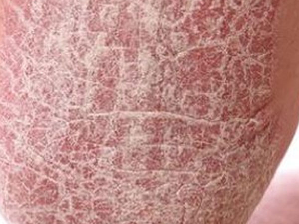 Hàng triệu người Việt mắc 'căn bệnh lạ' xù xì như cóc, nhiều người tuyệt vọng vì bị kỳ thị