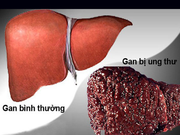 5 nguyên nhân khiến người Việt mắc và chết vì ung thư gan cao thứ 4 thế giới