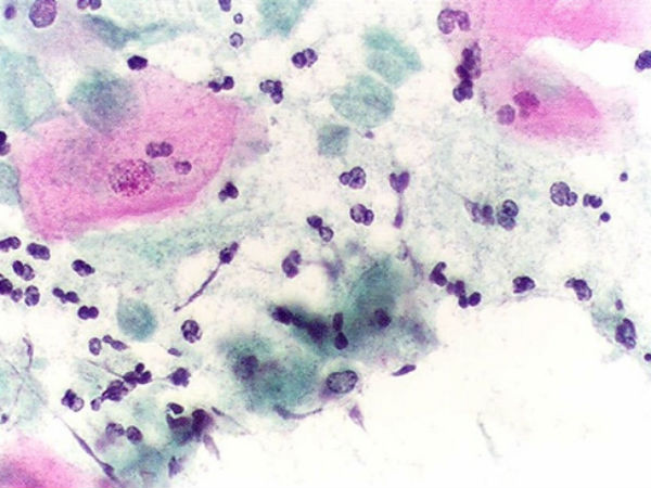 Nấm Candida sinh dục