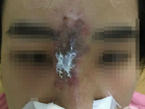 Nữ sinh viên 19 tuổi biến dạng mặt, suýt mù mắt vì tiêm nâng mũi tại 'thẩm mỹ viện chung cư'