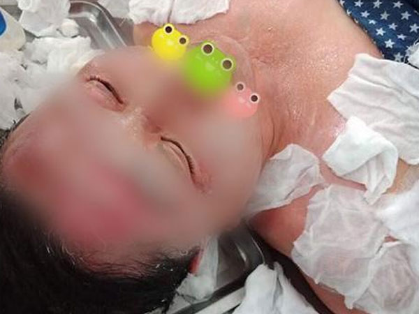 SỐC: Cô gái tưới cồn bật lửa xông da bị luộc chín mặt, da tróc thành mảng khó cứu vãn