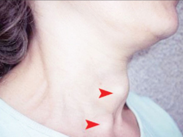 Nữ trung niên đột ngột lác hoàn toàn mắt trái vì lý do không ngờ