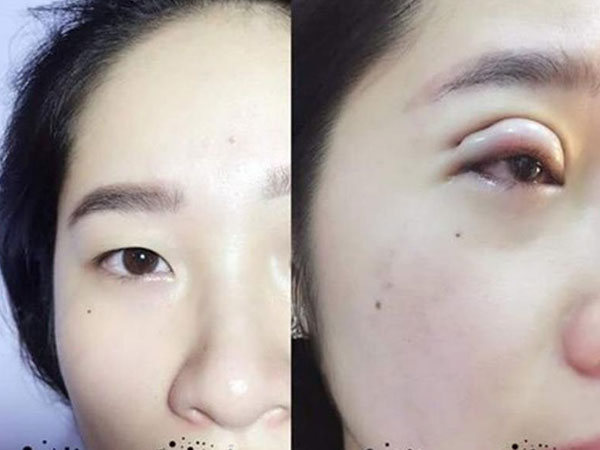 Nhìn những hình ảnh kinh hoàng này, chị em có cân nhắc lại về quyết định cắt mí mắt không?