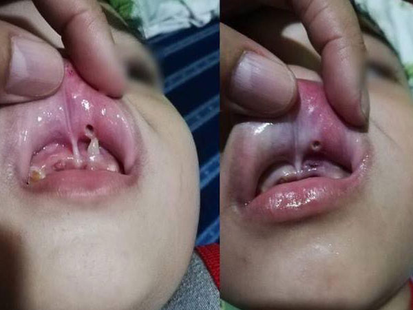 Hình ảnh kinh hoàng trong miệng đứa trẻ và lời cảnh báo đầy sức nặng dành cho cha mẹ