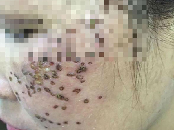 Chi cả trăm triệu làm đẹp mặt vẫn biến dạng, nhiều quý bà phải 'cầu cứu' bác sĩ