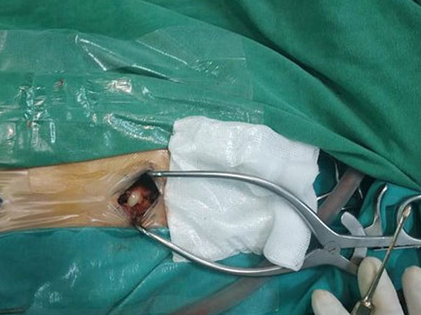 Vi khuẩn nguy hiểm 'bị lãng quên' tấn công bé trai 9 tuổi