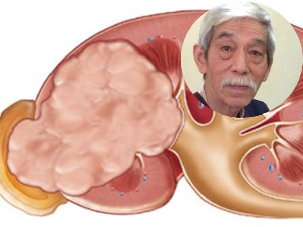 Những điều ít biết về căn bệnh ung thư thận diễn viên Ngọc Căn mắc phải