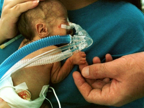 Nhiễm độc sữa mẹ được hút ra từ máy hút sữa, bé sơ sinh mắc bệnh viêm màng não hiếm gặp