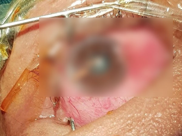 Chặt cây mây, người đàn ông bị gai đâm chi chít thủng mắt