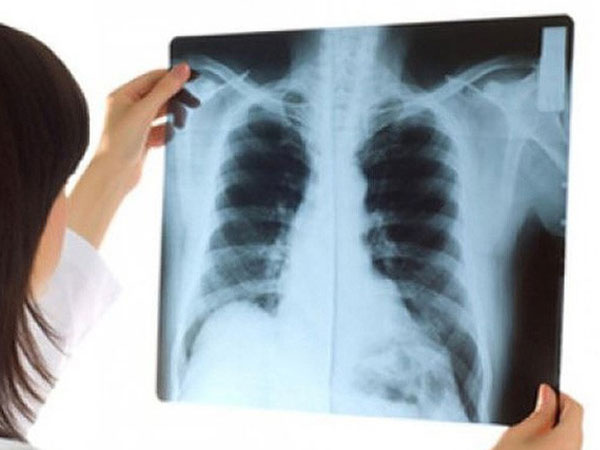 Dấu hiệu sớm căn bệnh 'sát thủ' làm 21.000 người Việt Nam chết mỗi năm