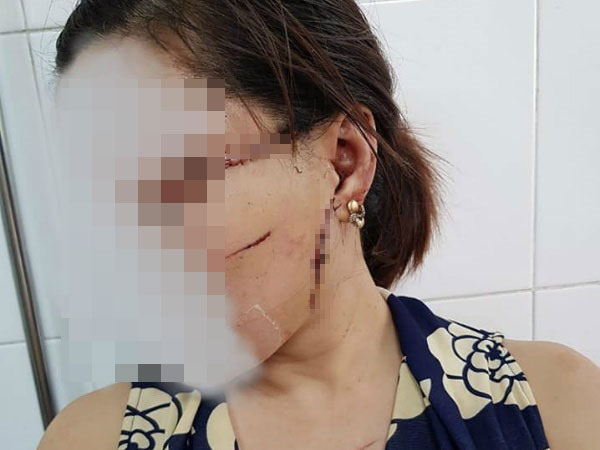 Gã chồng cắt gân chân vợ do ghen tuông lĩnh 27 tháng tù