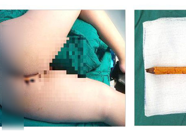 Ớn lạnh hình ảnh bé trai bị bị bút chì đâm thấu mông đến 8 cm