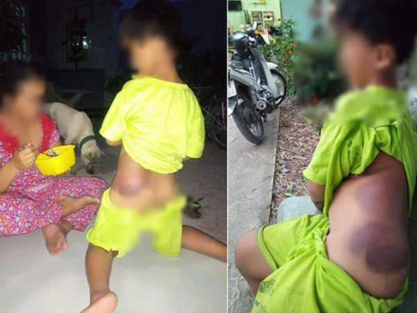 Mẹ học sinh lớp 1 khuyết tật bị giáo viên đánh bầm tím người: 'Đừng đuổi việc cô, do cô thương nên mới đánh bé'