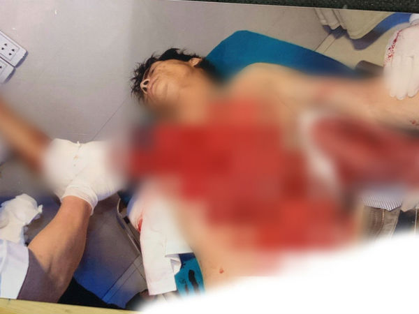 Tai nạn kinh hoàng: Ngã vào máy bóc gỗ, người đàn ông bị lột toàn bộ da phần ngực và tay