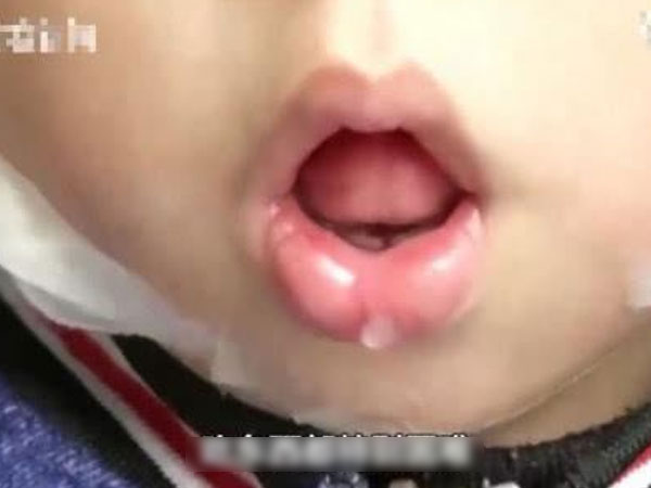 Bé trai 5 tuổi không thể ngậm được miệng, bị chẩn đoán mắc dị tật xương hàm vì thói quen của trẻ mà hầu hết phụ huynh đều bỏ qua