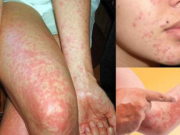 Trời lạnh, có thể chết vì dị ứng thời tiết