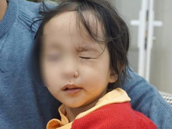 Trời rét đậm, rét hại, nhiều trẻ bị liệt mặt, méo miệng