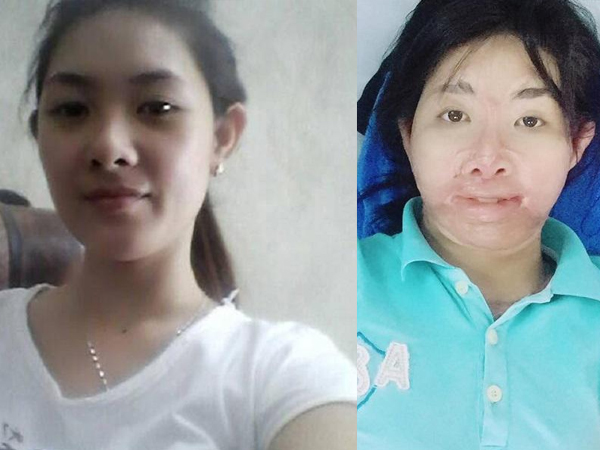 Sau 700 ngày bị chồng tẩm xăng đốt, người mẹ từng rất xinh đẹp đếm ngược để được gặp con