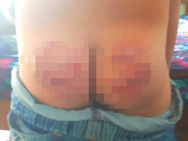 Thầy giáo đánh con của đồng nghiệp bầm tím mông