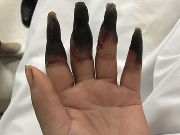 Dọn nhà, người phụ nữ bị hoại tử 8 ngón tay đen sì: Triệu chứng bất thường mọi người phải hết sức cảnh giác