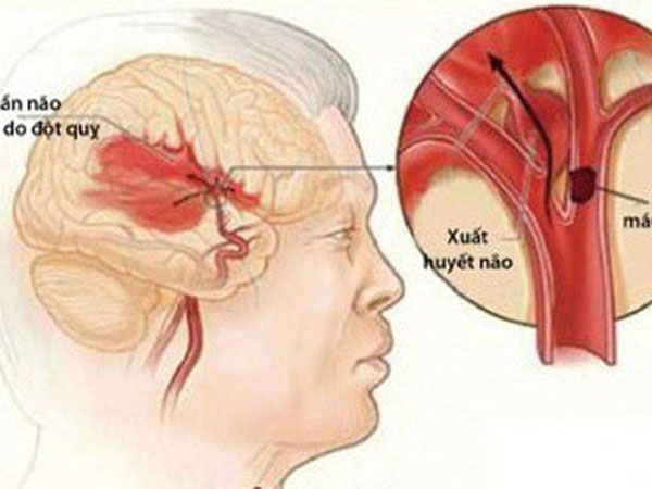 Chủ tịch hội đột quỵ Việt Nam: 5 dấu hiệu cảnh báo đột quỵ bất cứ ai cũng phải thuộc lòng