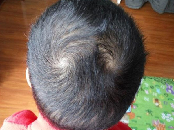 Thực hư câu nói ‘Một xoáy sống lâu, hai xoáy trọc đầu, ba xoáy chết yểu, 4 xoáy làm quan’?