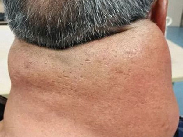 26 năm uống rượu, người đàn ông thành ‘quái vật’ với chiếc cổ kì dị