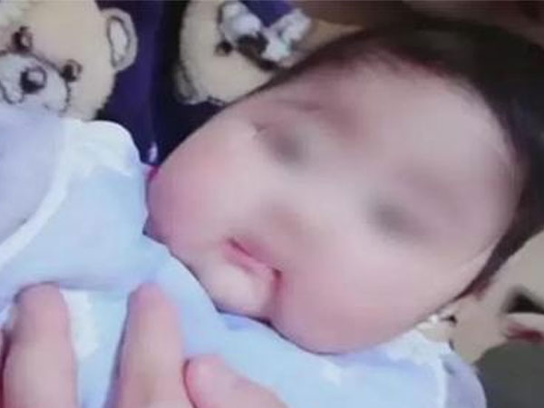 Tưởng con dậy thì sớm vì lông mày mọc rậm nhưng BS nói vấn đề còn nghiêm trọng hơn